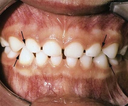 Яагаад 3-5 настай хүүхдийн шүд зайтай болдог вэ?