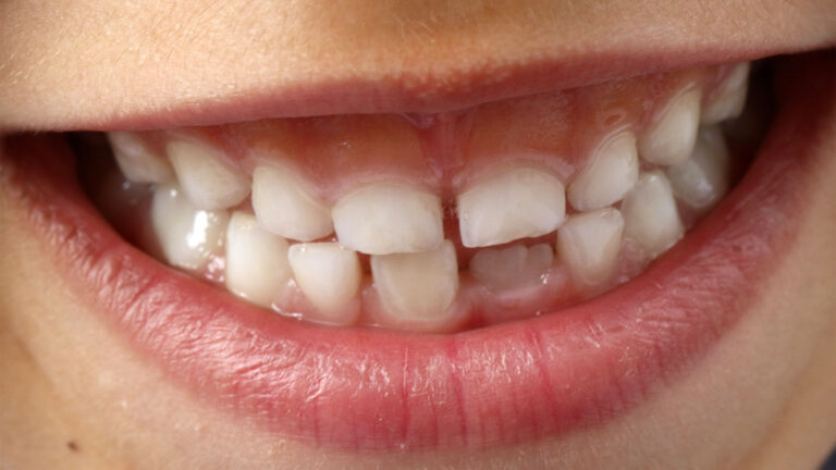 Яагаад 3-5 настай хүүхдийн шүд зайтай болдог вэ?